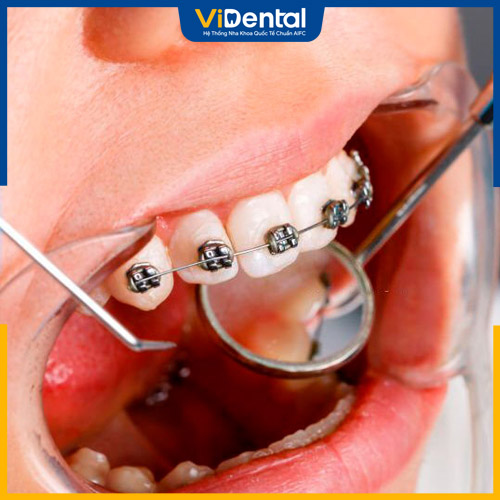 Quá trình niềng răng hô gồm 6 bước