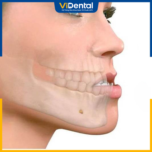 Răng móm chính là tình trạng khớp cắn ngược
