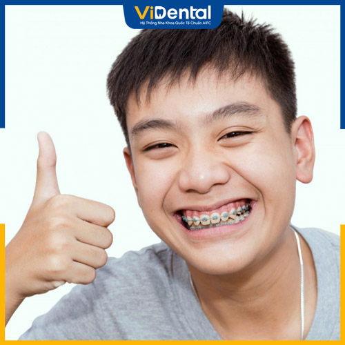 Thời điểm “vàng” để niềng răng cho trẻ là giai đoạn 12 - 16 tuổi