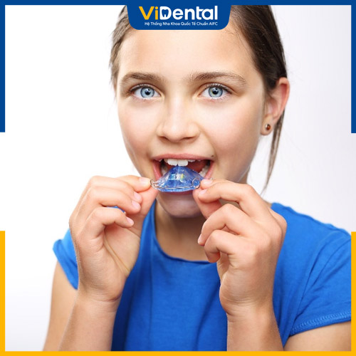 Niềng răng tháo lắp thích hợp cho trẻ ở giai đoạn thay răng sữa
