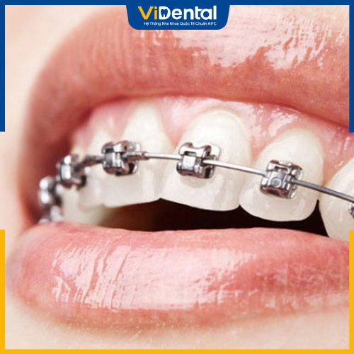 Phương pháp niềng răng mắc cài kim loại tự động mang lại nhiều ưu điểm vượt trội