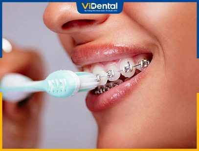 Top 5 Bàn Chải Cho Người Niềng Răng & Cách Chải Răng