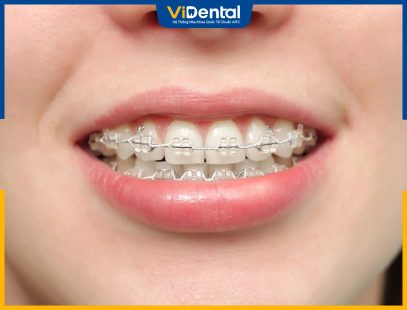 Làm Răng Sứ Có Niềng Răng Được Không? Chuyên Gia Giải Đáp