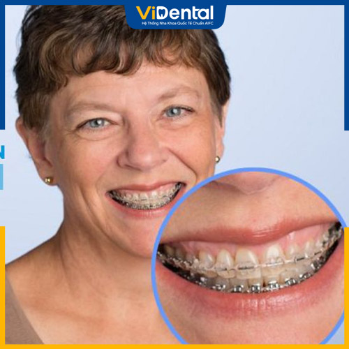 Từ 35 - 50 tuổi vẫn có thể niềng răng như bình thường
