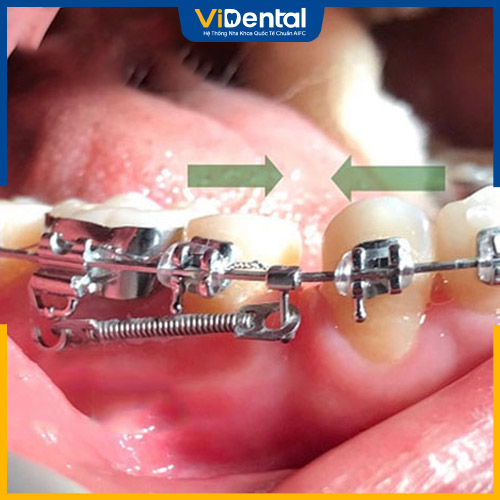 Đóng khoảng trong niềng răng sẽ nằm ở giai đoạn thứ 3 trong quá trình niềng