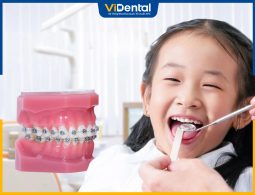 Giá niềng răng cho trẻ 10,11,12 tuổi