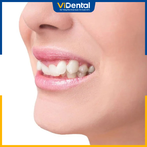 Niềng răng khấp khểnh giúp di chuyển răng về đúng vị trí, tránh lệnh lạc