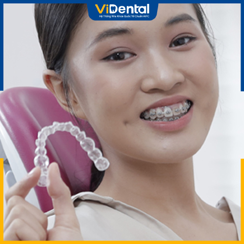 Mỗi phương pháp niềng răng đều có những ưu, nhược điểm riêng