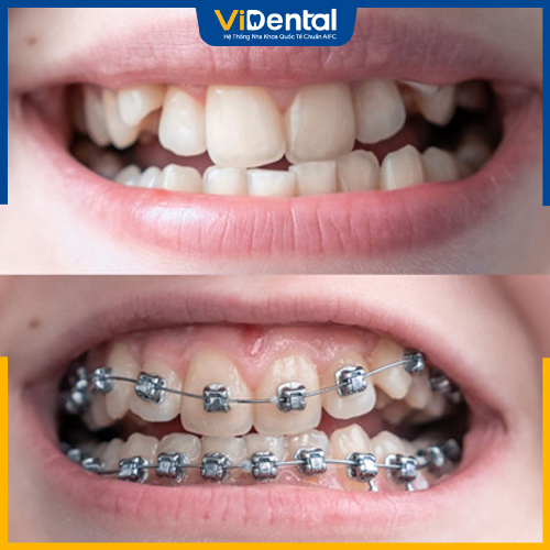Tình trạng răng khấp khểnh càng nặng thì thời gian chỉnh nha sẽ kéo dài hơn