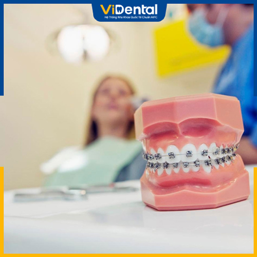 Quy trình niềng răng khớp cắn sâu có giá dao động từ 20 - 65 triệu đồng