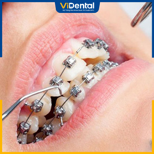 Khi thực hiện siết răng, sẽ khó có thể tránh khỏi cảm giác đau nhức