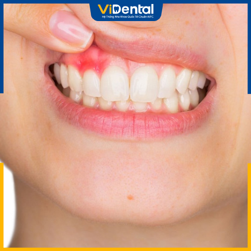 Chăm sóc răng miệng không đảm bảo có thể gây viêm lợi