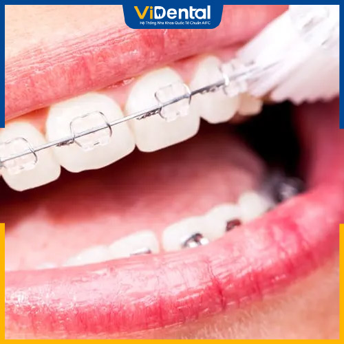Chăm sóc răng miệng không đúng cách gây ảnh hưởng tới kết quả niềng răng