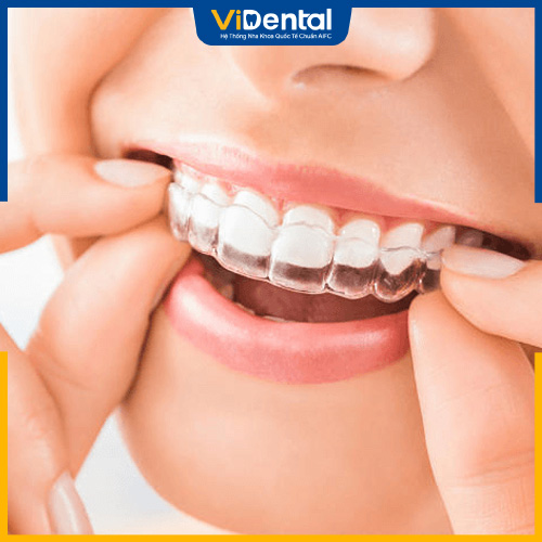 Niềng răng Zenyum là một phương pháp niềng răng trong suốt